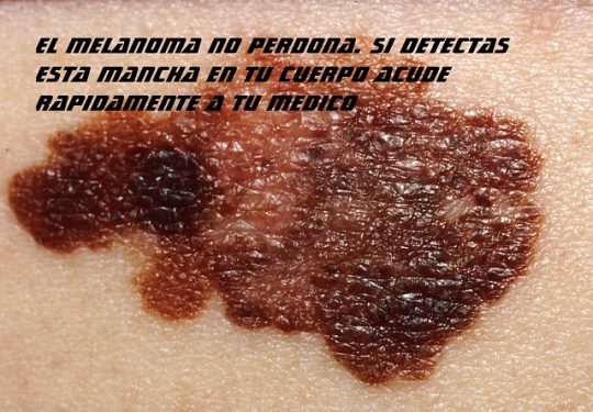 melanoma