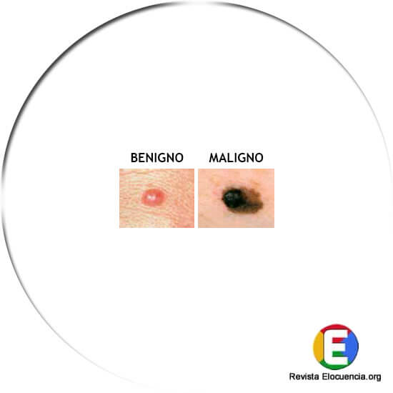 signos melanoma asimetría