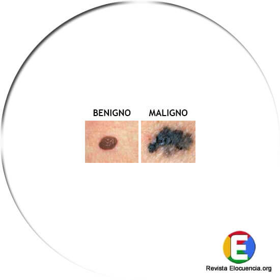 signos melanoma los bordes