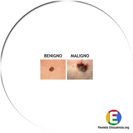 signos melanoma color