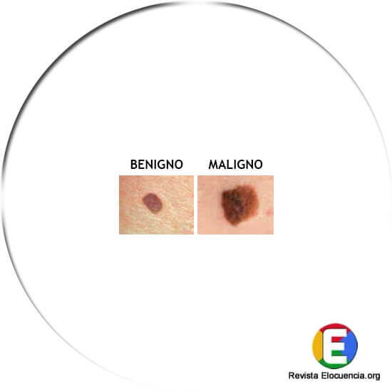 signos melanoma diametro