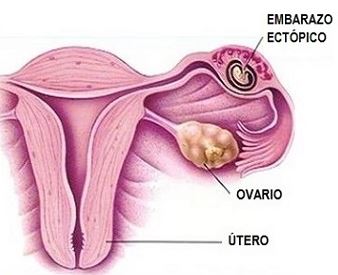 Cómo saber si tengo gonorrea Embarazo ectópico