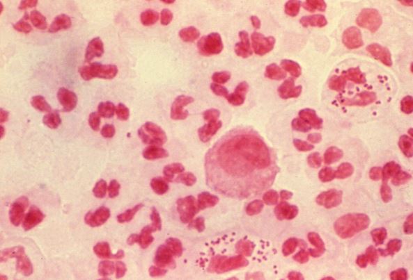 cómo saber si tengo gonorrea Bacteria gonococo