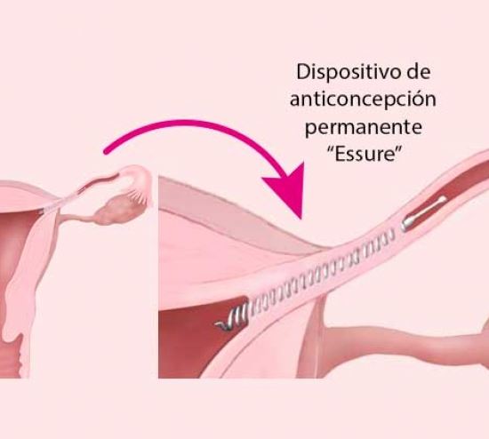 essure colocacion