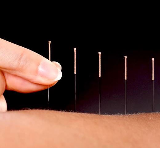 medicinas complementarias acupuntura