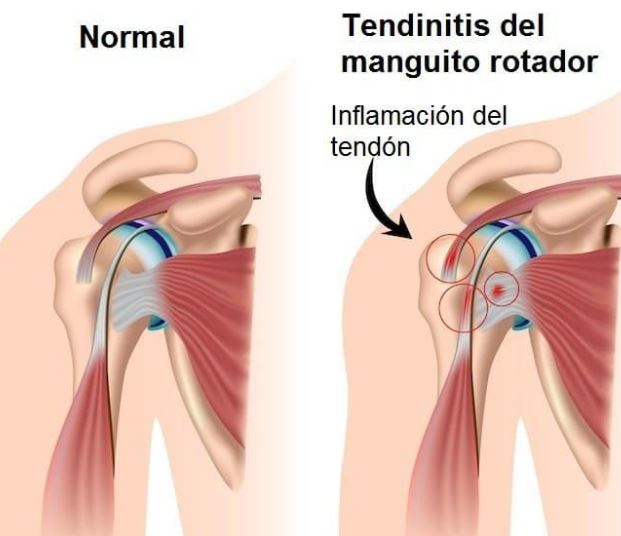 tendinitis ejemplo