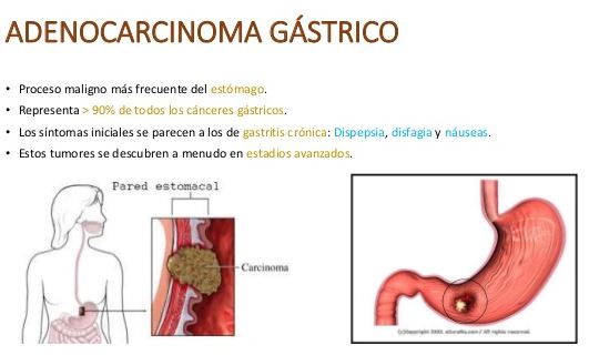 graviola para adenocarcinoma gastrico y pulmonar