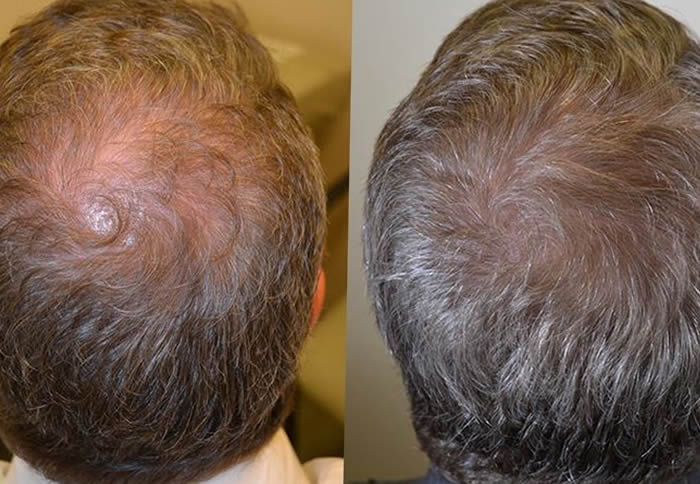 finasteride portada