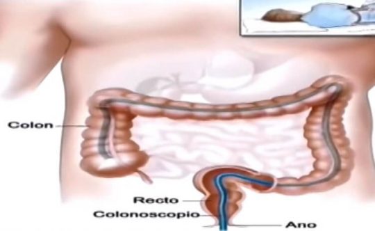 que es una endoscopia inferior colonoscopia 2