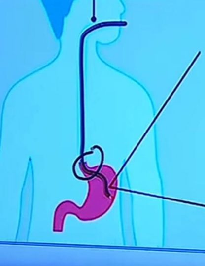 que es una endoscopia superior 2