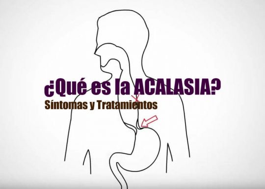 acalasia esofagica sintomas tratamiento 1