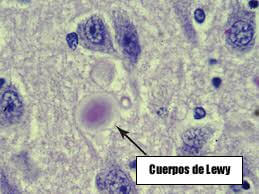 cuerpos de lewy