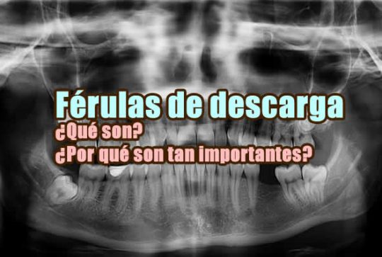 imagen del artículo sobre férulas de descarga en la que aparece una radiografía de una boca humana